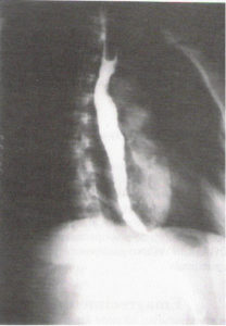 Acalasia Coluna de Bario Radiografia